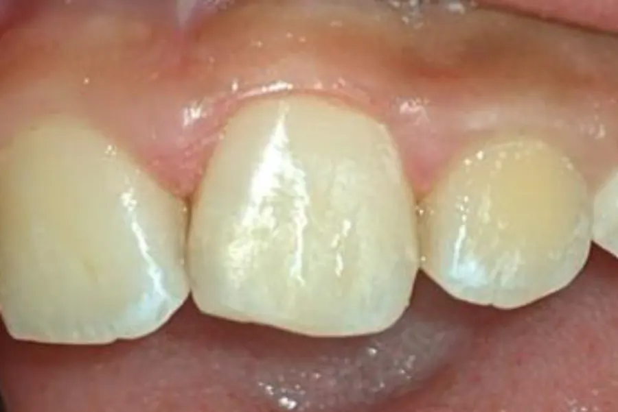The same teeth after composite bonding, with even edges