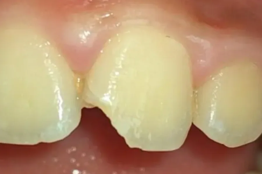 Upper front teeth with a broken corner on one central incisor