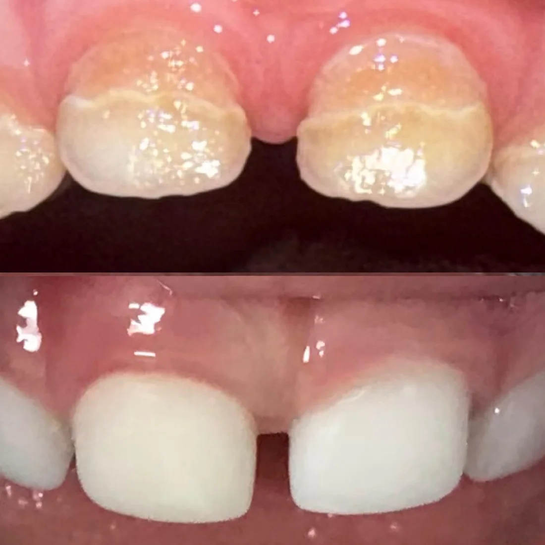 Upper front teeth with early childhood decay, and the same teeth after white crowns