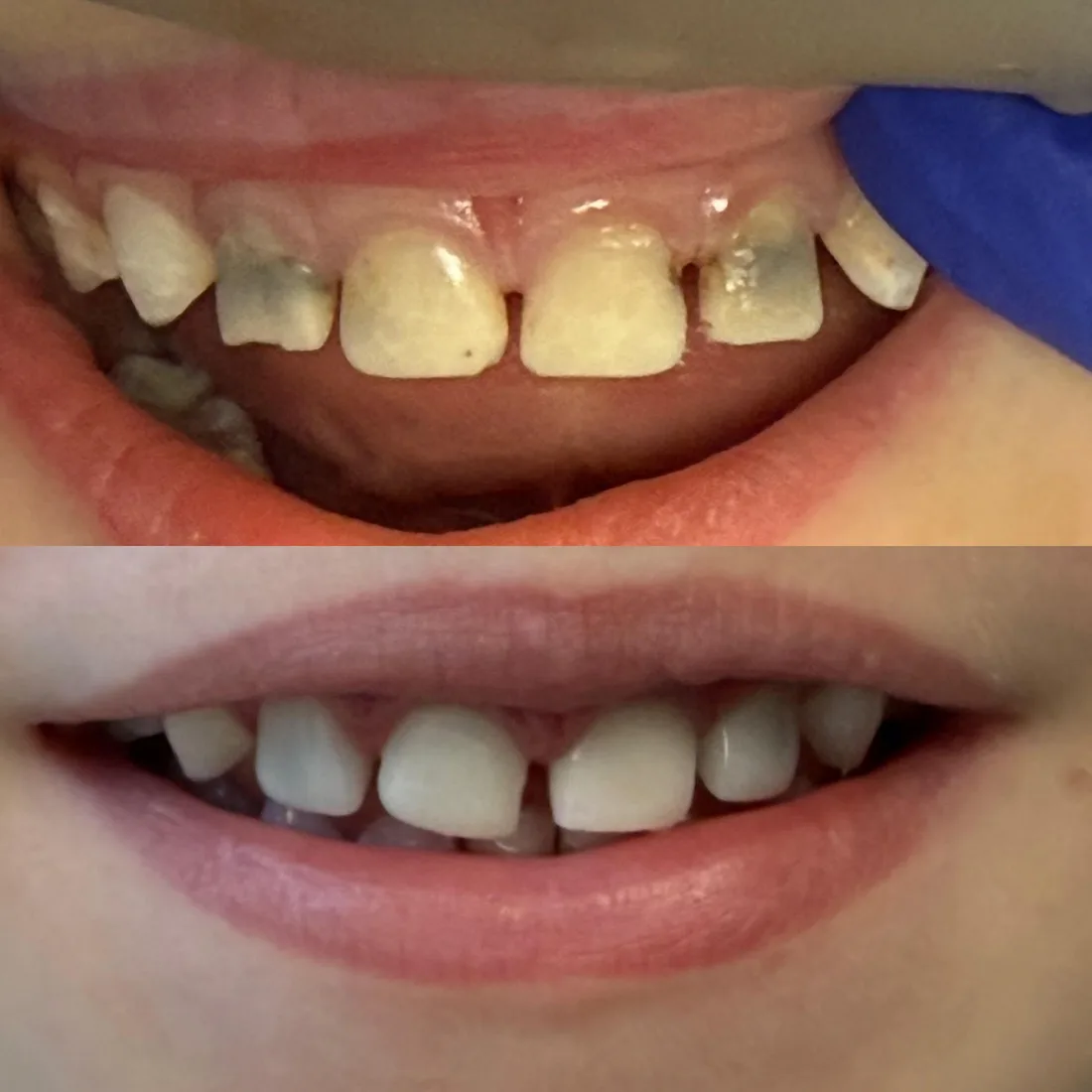 Discoloured upper front teeth, and the same teeth after white crowns