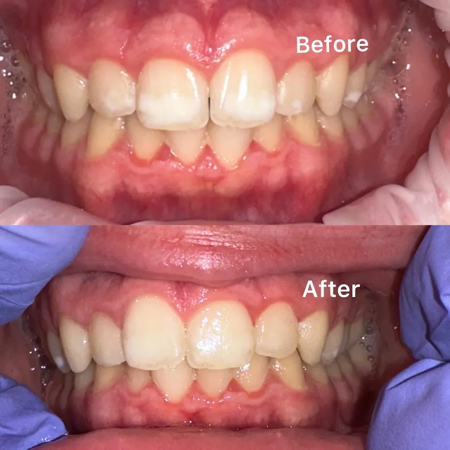 Before and after ICON resin infiltration: white patches on the upper front teeth, then an even shade