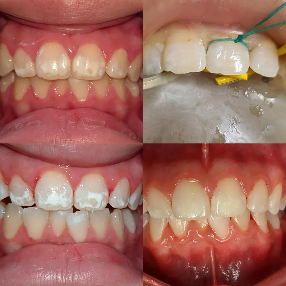 Four views of an ICON case: the white marks, the separator and matrix in place during treatment, and the result