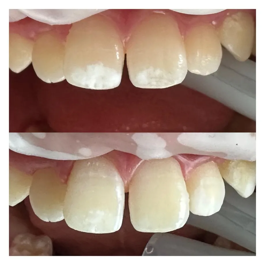 A closer before and after of ICON resin infiltration on two upper front teeth