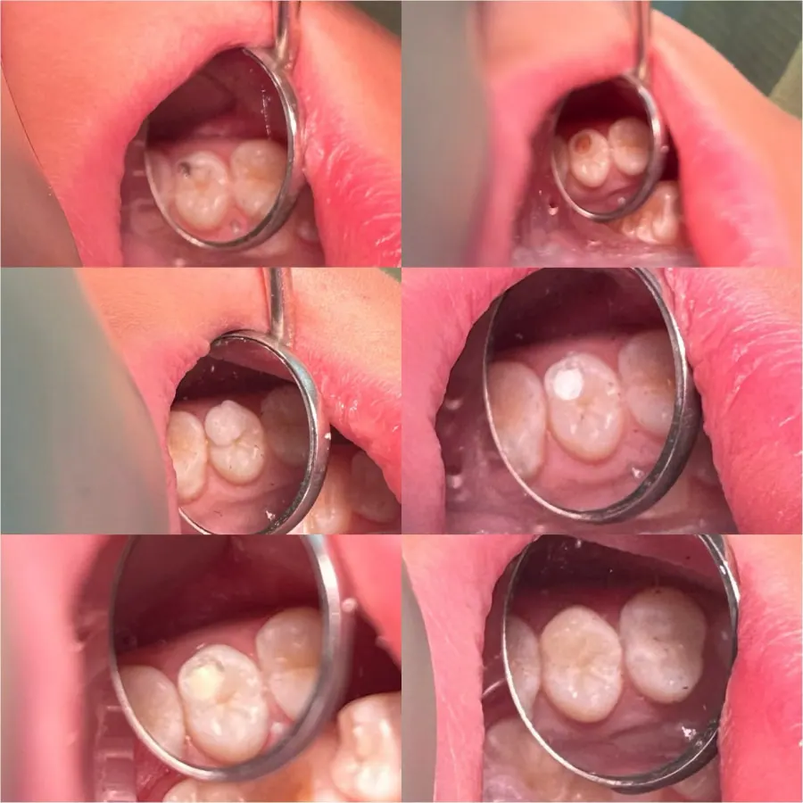 Six mirror views of a molar treated for decay under Isolite isolation