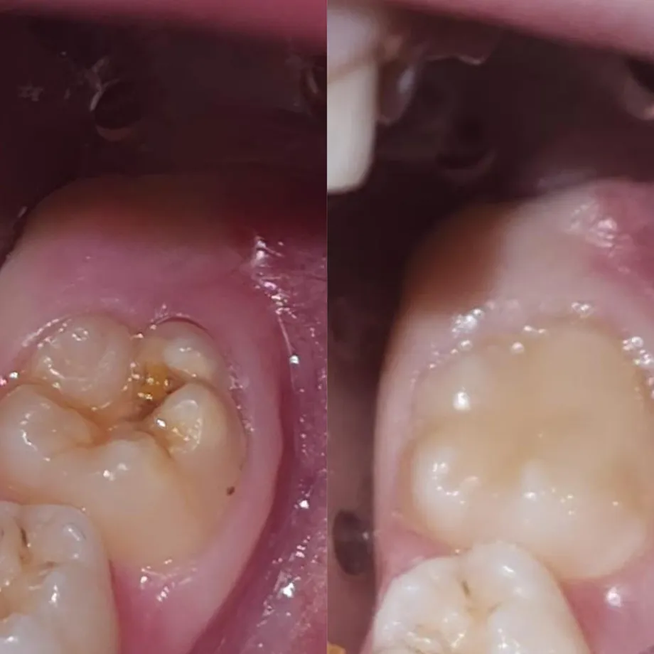 A first permanent molar affected by Molar Incisor Hypomineralization, before and after treatment
