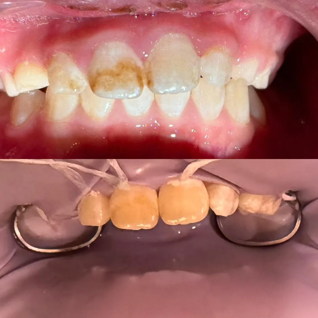 Before and after ICON: brown decay across the upper front teeth, then an even shade
