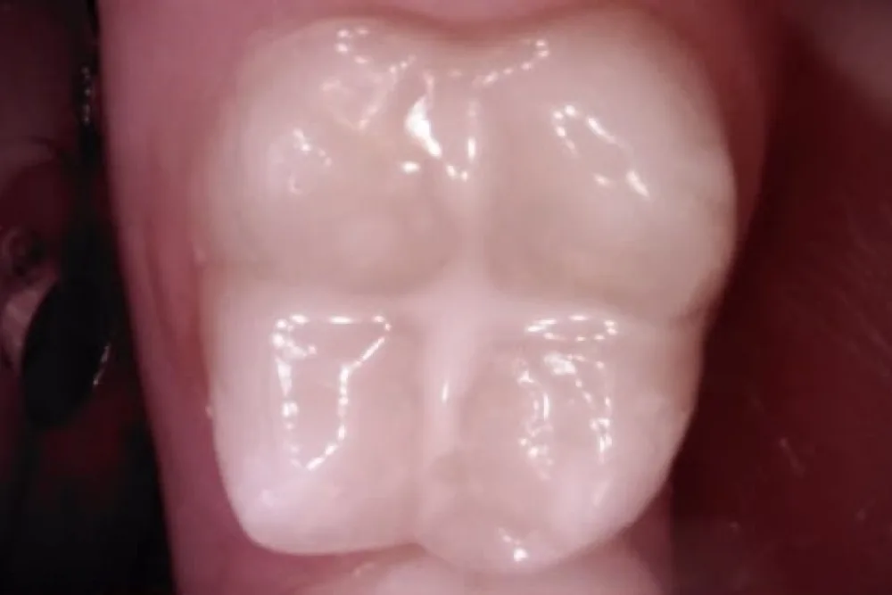 The same molar after sealing, the grooves filled and the surface smooth