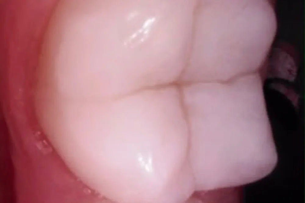 The chewing surface of a back molar, its natural pits and grooves still open