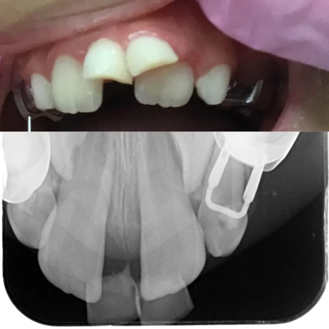 An adult tooth coming through behind the baby teeth, with the X-ray of the same mouth below
