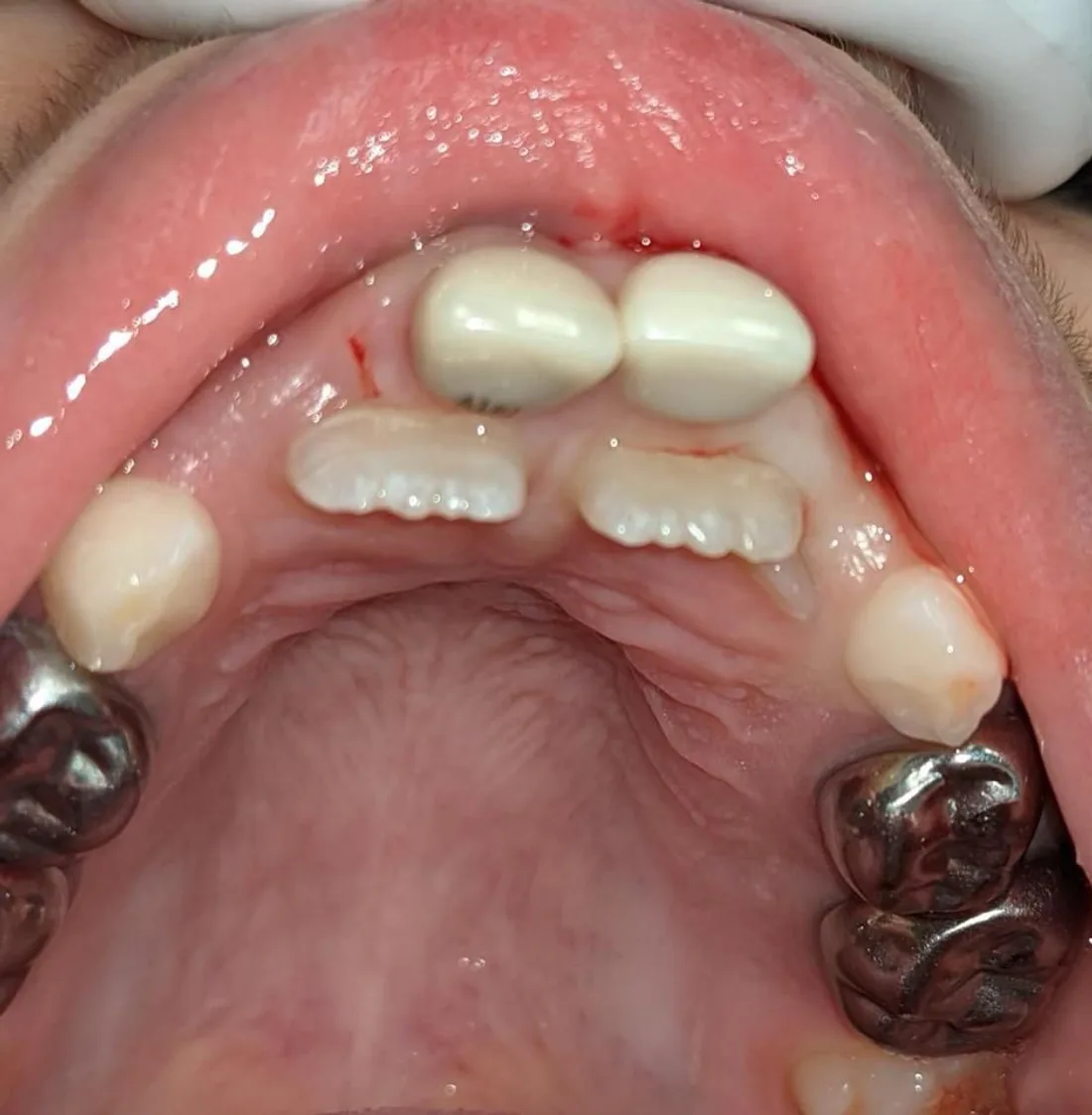 Looking down on the upper arch, adult teeth erupting behind the baby front teeth