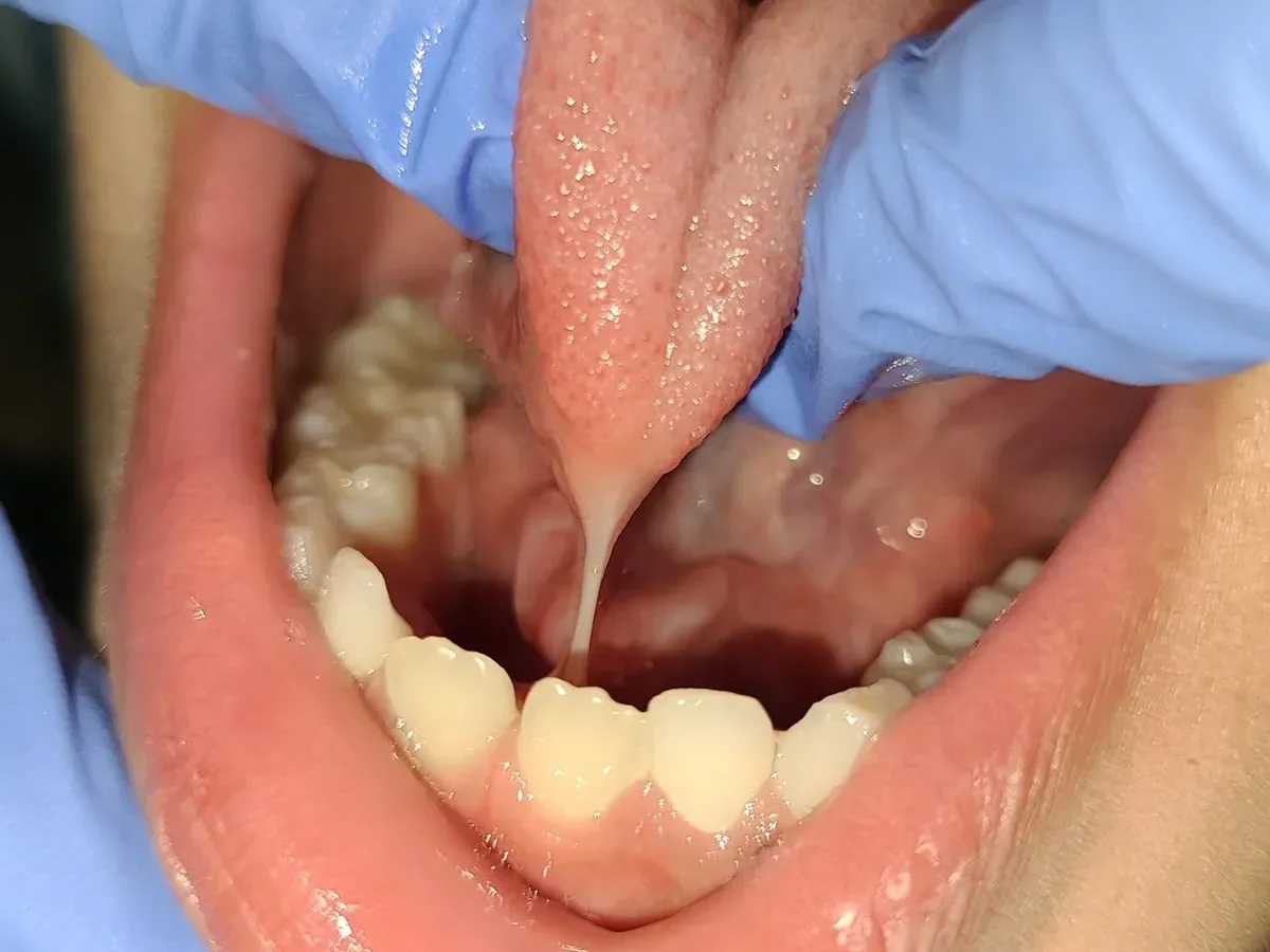 A child's tongue lifted, with the frenum stretched tight between the tongue and the floor of the mouth