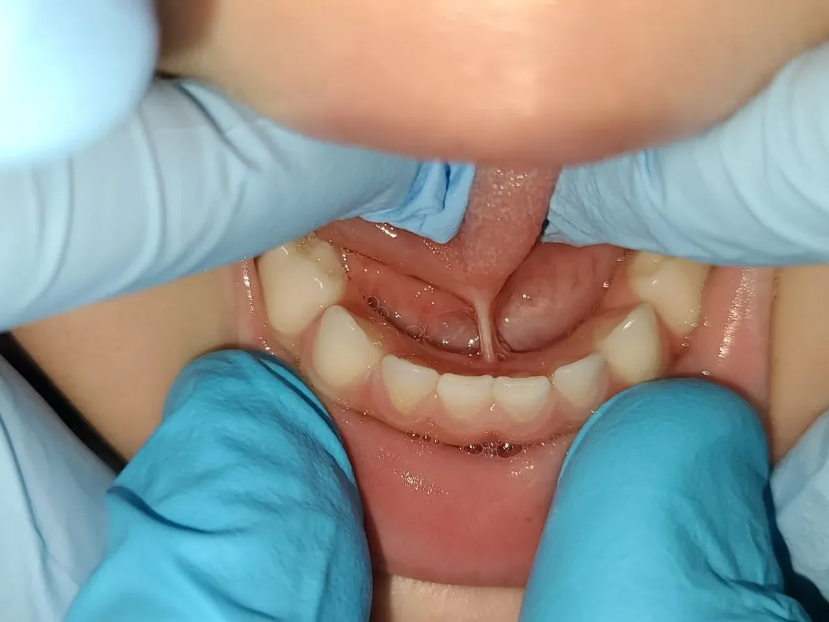 Looking down at the lower teeth with the tongue held up, showing how far the frenum limits it