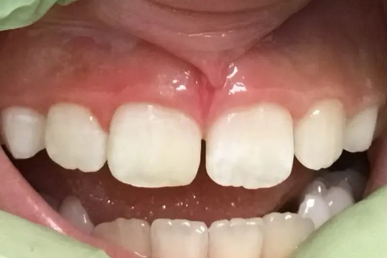 The same tooth after composite bonding, matching its neighbours