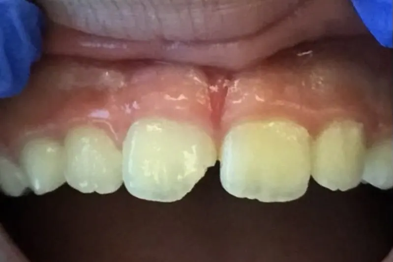 An upper central incisor darkened after an injury