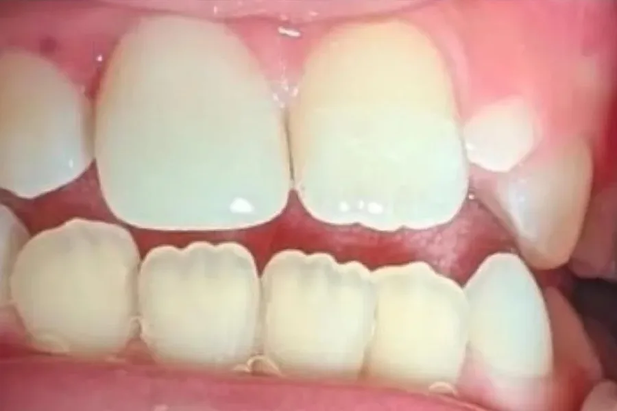 The same teeth after composite bonding, the edges rebuilt and even