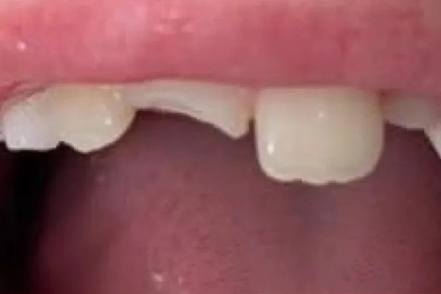 Upper front teeth broken across the biting edge after a fall