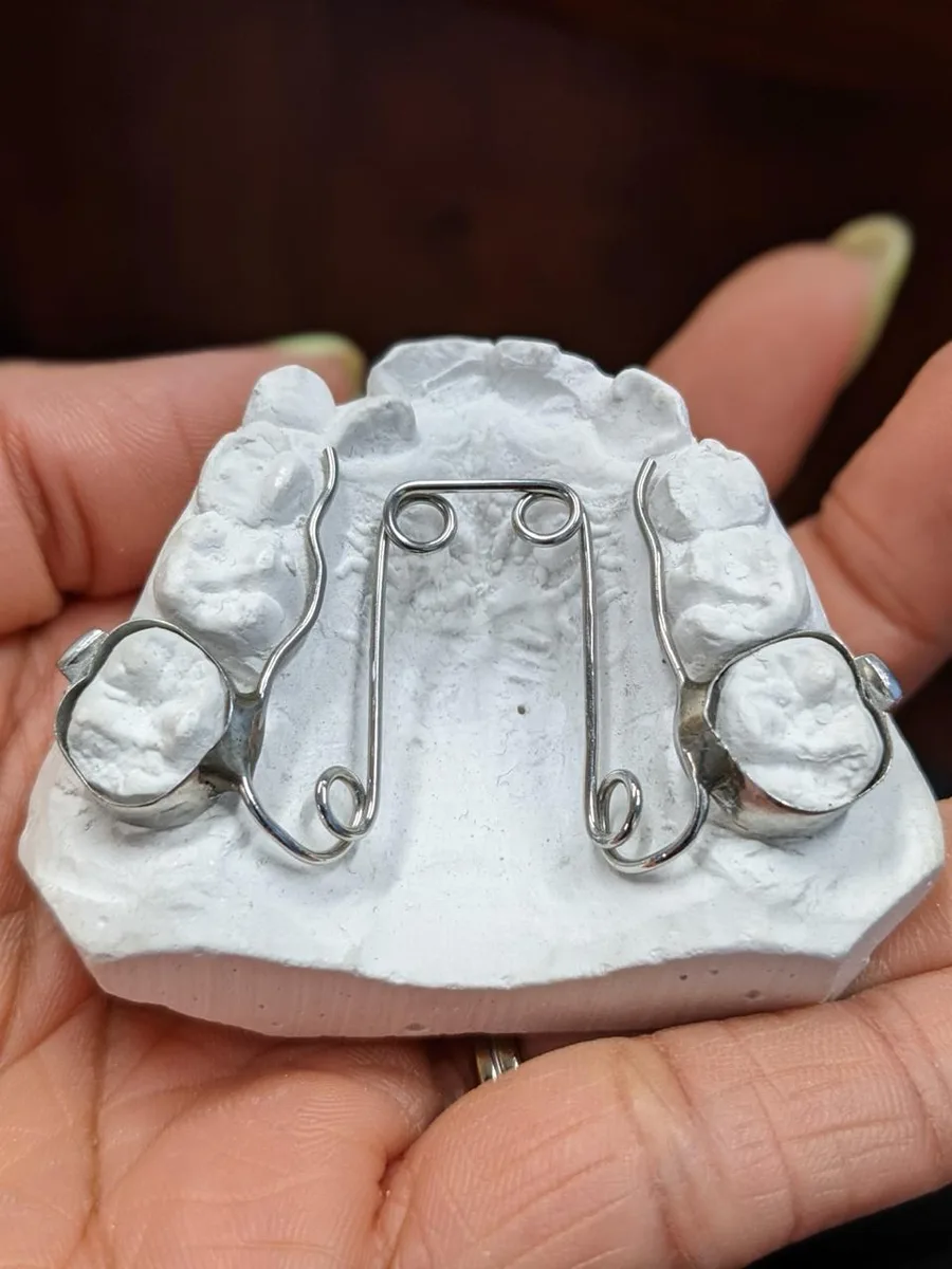 A custom upper appliance on a plaster model of a child's teeth, with bands on the back teeth and shaped wires across the palate