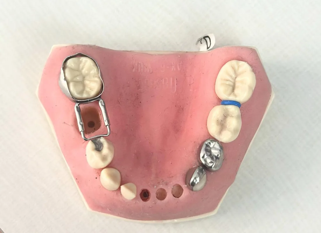 A teaching model showing stainless steel crowns on back teeth and a band and loop space maintainer holding the gap where a tooth is missing